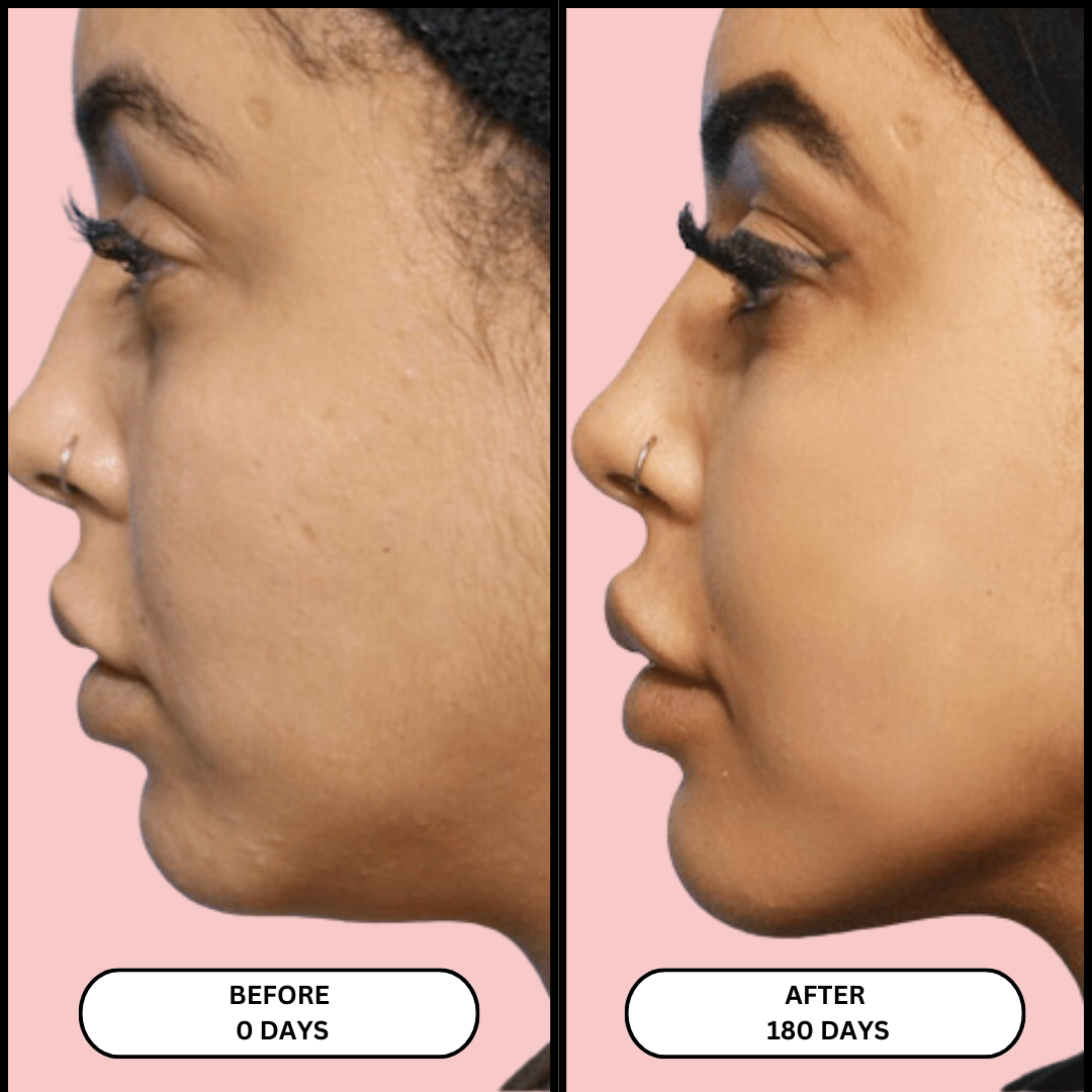 Facial Therapy Sculptor